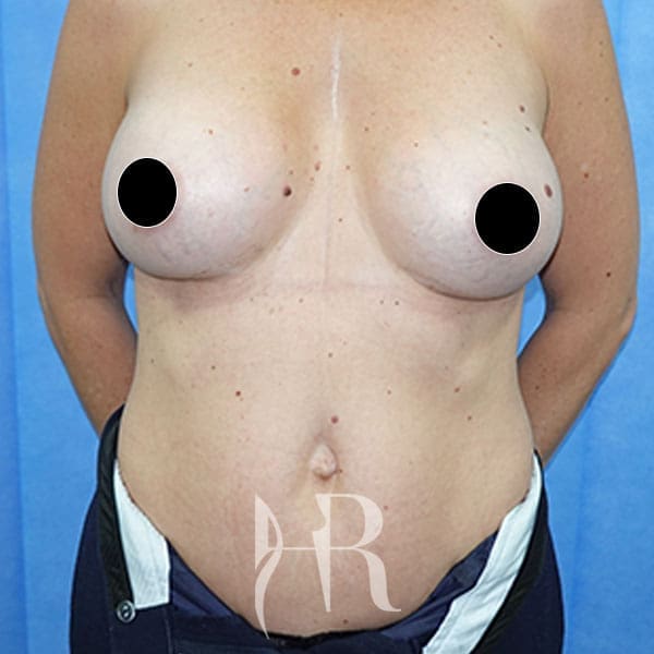 HR Plastic Surgery - Breast Enlargement patient after 9